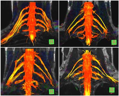 Diffusion Tensor Imaging for Diagnosing Root Avulsions in Traumatic Adult Brachial Plexus Injuries: A Proof-of-Concept Study